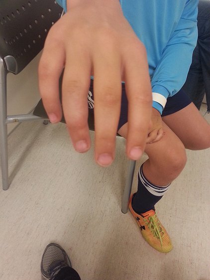 2016-09-11 19.46.16 Zoe's ring finger bending in a way it's not designed to do. This is what can happen when you try to stop a point-blank shot.